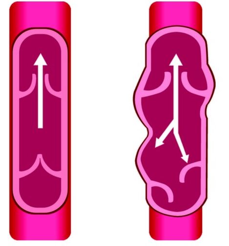 Pathologie der Venen