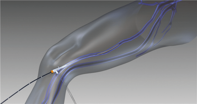 Radiofrequenz-Obliteration bei Krampfadern