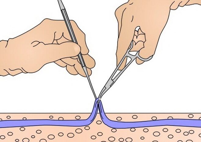 Venenstripping bei Krampfadern