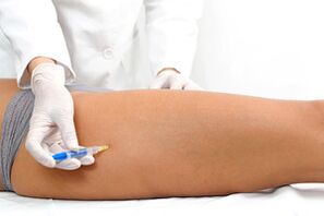 Sklerotherapie als Methode zur Behandlung von Krampfadern